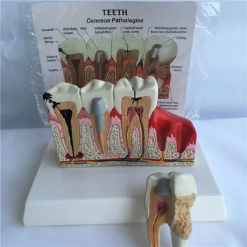 Кариес модель заболевания зубов Фарфоровые коронки зубов Гингивит, периодонтит, зубной камень в зубах распространенная патология